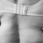 Des questions sur la liposuccion